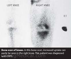 Complex Regional Pain Syndrome Following Multiple Knee Surgeries Caring Medical Florida