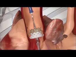 Transcatheter Heart Valve With The Edwards Commander System How It Works Youtube