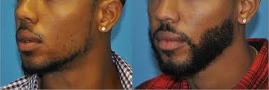 Facial Hair Restoration