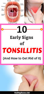 10 Early Signs Of Tonsillitis And How To Get Rid Of It Health Healthy Symptoms Homereme Remedies For Swollen Tonsils Tonsilitis Remedy Swollen Tonsils
