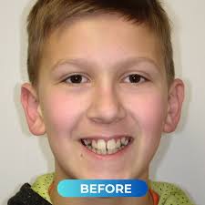 Your dream smile is just one step away with Chris Cusimano Orthodontics!  Start your transformation today and feel the difference. #Braces #Nampa  #NampaIdaho