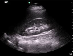 Kidney Ultrasound Sonography Ultrasound Diagnostic Medical Sonography