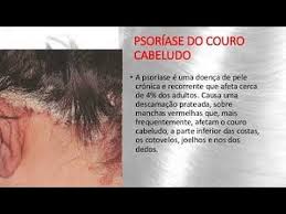Pode ser difícil diferenciar entre a psoríase do couro cabeludo e a dermatite seborreica, quando apenas o couro cabeludo está envolvido. Glicerina Para Psoriase Glicerina Psoriasis Treatment Youtube