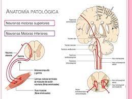 Amyotrophic lateral sclerosis is a neurodegenerative disease with devastating consequences for the patient and his/her family. Esclerosis Lateral Amiotrofica Neurology Neuromuscular Neuro