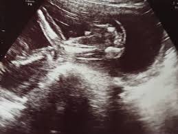 Ultraschallbilder Mehr Als 50 Bilder Aus Der Schwangerschaft Faminino