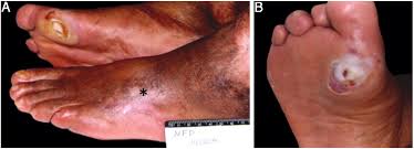 Martorell hypertensive ischemic leg ulcer. Scielo Brasil Consensus On The Diagnosis And Management Of Chronic Leg Ulcers Brazilian Society Of Dermatology Sup Sup Consensus On The Diagnosis And Management Of Chronic Leg Ulcers Brazilian Society