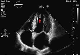 Image result for Nuclear Ventriculogram