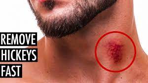 May 10, 2021 · how to get rid of pimples, fast ; Best Ways To Get Rid Of Or Hide A Hickey Remove A Hickey Fast Tiege Hanley Youtube