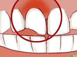 How To Treat A Broken Tooth With Pictures Broken Tooth Tooth Repair Broken Tooth Repair