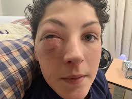 Capnocytophaga sputigena as a cause of severe orbital cellulitis and  subperiosteal abscess in a child