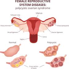 The symptoms of pcos include excess hair growth (hirsutism), scalp hair loss, acne, irregular or infrequent periods, weight gain, difficulties with fertility and increased anxiety and depression. What Is Pcos Symptoms And Treatments For Polycystic Ovary Syndrome