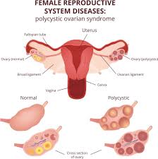 Pcos can be a complex condition to diagnose. What Is Pcos Symptoms And Treatments For Polycystic Ovary Syndrome
