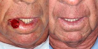 Image result for Lip Cancer