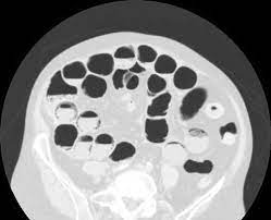 All of the following are true about iodinated intravascular contrast media xcept. Abdomen Quiz Radiology Cafe