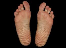 How To Prevent And Cure Athlete S Foot Prime Insurance Agency In Lakewood New Jersey