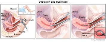 Uterine cancer treatment should have a complex approach and usually it depends on multiple factors. Endometrial Cancer Hematology Oncology Associates Of Cny