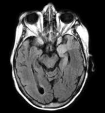 Contrast enhancement is uncommon during the first week of the disease. Herpes Encephalitis2