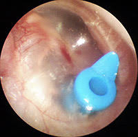 Meniere S Disease