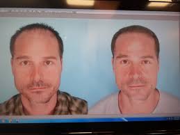 Alan Bauman, MD, Board Certified Hair Restoration Surgeon