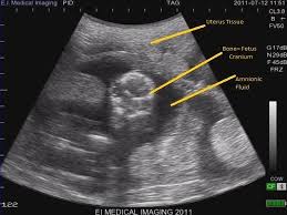 Ultrasound Basics How To Read An Ultrasound Image Ultrasound First Ultrasound Reading