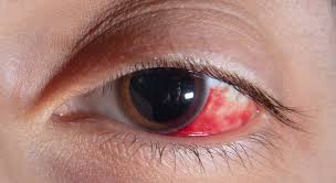 Image result for Eye Pain without Redness