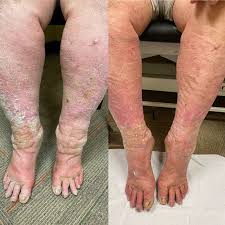 Image result for Stasis Dermatitis