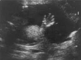 Image result for Biophysical Profile