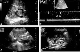 Primary Budd Chiari Syndrome Outcome Of Endovascular Management For Suprahepatic Venous Obstruction Journal Of Vascular Surgery