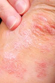 Image result for psoriasis