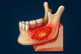 Image result for Osteomyelitis