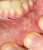 Bump on roof of mouth that randomly appeared with a little pain. Mouth Ulcer Wikipedia