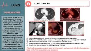 A response that the parenchyma tumor is in the peripheral lung. Epos Trade