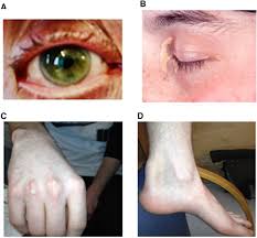 Image result for Hypercholesterolemia