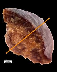 Kidney Stones Undergo A Dynamic Process Of Growing And Dissolving Haptic