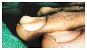 Image result for Koilonychia feet