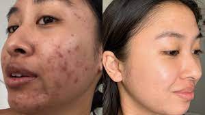 The tretinoin purge usually lasts for two to six weeks, although it can sometimes carry on for as long as two or three months. I Tried Differin Gel For A Whole Year Aiko Sipe Youtube