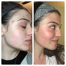 After 24 weeks of treatment with adapalene/benzoyl peroxide gel, atrophic acne scarring and lesions were reduced, and results were maintained after 48 the lack of a control group in the second part of the study was cited as a limitation. 4 Months Of Differin Gel Life Changing Acne