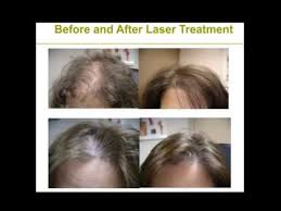 This therapy is also known as cold laser therapy, because the treatment does not produce any physical heat. Red Light Therapy For Hair Growth Does It Work
