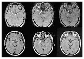 A brain aneurysm is a bulge or ballooning in a blood vessel in the brain. Mri Imaging Of Changes In Aneurysm Size And Flow Over Time In Patient 9 Download Scientific Diagram