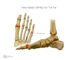 It mainly causes intense pain in joints. Stiff Big Toe Hallux Rigidus Orthopaedic Charlie Jowett