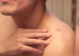 Ketahui juga cara mengobati bisul yang ampuh di rumah. Bisul Jenis Penyebab Gejala Pengobatan Dan Pencegahan