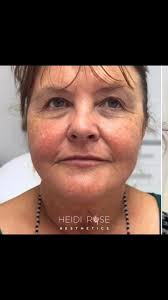 Thank you so much to my lovely patient for allowing me to share her 9 month  progress results. , What did we do to achieve these results ? , We restored  the lateral and anterior cheek with dermal ...
