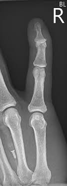 If there is no fracture, then the assumption is that the end of the tendon has been ruptured, allowing the end of the finger to droop. Mallet Finger Radiology Case Radiopaedia Org