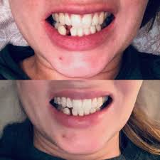 For example, if you go to your dentist and ask how to fix gaps in teeth, they may recommend porcelain veneers, which can cause damage to the natural teeth and. Invisalign Gap Teeth Before And After Reddit