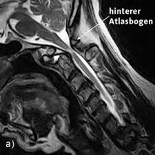 Aufgrund dieser funktion wurde sein name vom titanen atlas der griechischen mythologie entlehnt, der die last des himmels auf seinen schultern stemmen musste. Upright Mrt De Instabilitat Im Cervicooccipitalen Ubergang