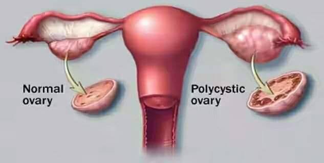 PCOD Disease product image