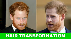 marrying Meghan, Hair Transplant ...
