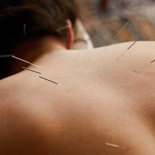 Acupuncture for Pain After Surgery in Dubai at Yuan Qi Acupuncture Center, Business Bay Dubai