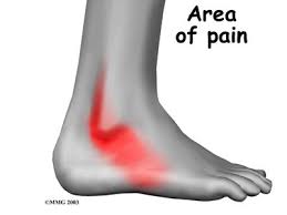 It can make standing, walking, or running painful. Pin On Health