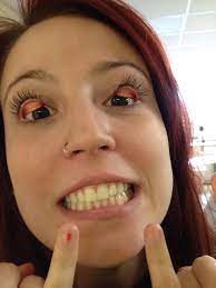 Eyelid flip / c bao co eyelid flip. Flip Eyelids Flippedeyelids